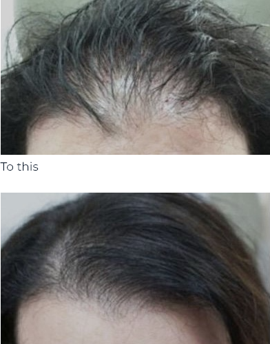 Revifol Before & After Results
