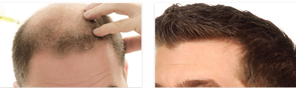 Hair Revital X for men